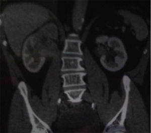 La imagen de la tomografía muestra un tumor sólido de polo superior del riñón derecho y defecto de llenado a nivel de pelvis del riñón izquierdo.