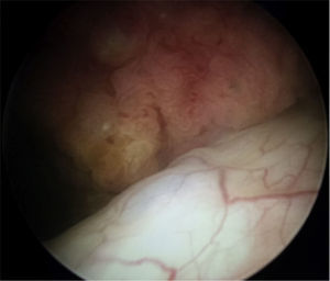 Durante la cistoscopia realizada se identifica tumor pediculado, arborescente, posterior al meato ureteral izquierdo.
