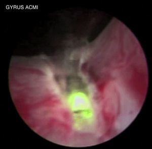 Incisión a nivel de las 5 y las 7 del reloj. Se realiza incisión en el radio de las 5 y las 7 del reloj, iniciando a nivel del cuello vesical hasta la marca a nivel de verum montanum, profundizando posteriormente la incisión hasta la cápsula prostática.