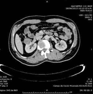 Tumor renal derecho que refuerza en fase arterial de urotomografía.