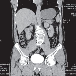 Corte coronal de urotomografía evidenciando tumor renal dependiente del polo superior del riñón derecho.