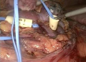 Isquemia mediante ligas vasculares en 2 arterias renales derechas.