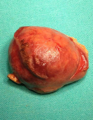 Imagen macroscópica del tumor renal.