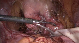 Vista final del procedimiento quirúrgico. Se instila agua a la vejiga a través de la sonda transuretral para verificar impermeabilidad de la misma. Se coloca drenaje en cavidad abdominal.