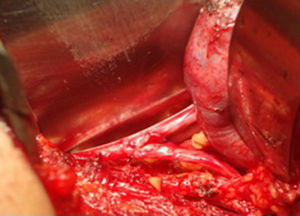 Imagen de procedimiento quirúrgico, uretero-ureteroanastomosis del uréter superior al inferior izquierdo.