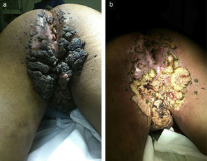 a) Fotografía clínica que muestra la severidad de las lesiones perianales. b) Aspecto de la zona quirúrgica posterior a la escisión de las lesiones perianales.