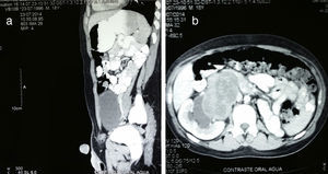a) Imagen tomográfica de un corte sagital que demuestra una lesión retroperitoneal. b) Corte coronal que muestra la lesión retroperitoneal que comprime el hilio renal derecho.