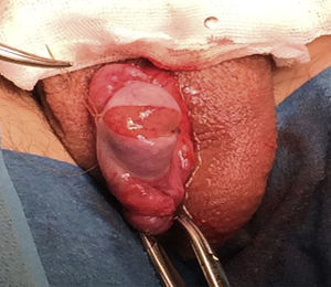 Técnica quirúrgica. Disección del parénquima testicular.