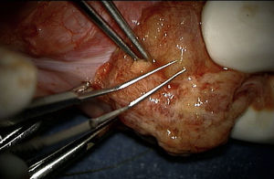 Microdisección profunda del parénquima testicular (vista a través de microscopio).