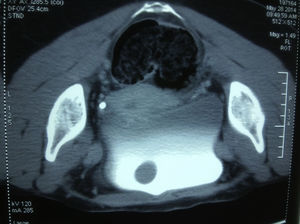 Tomografía de abdomen y pelvis con medio de contraste intravenoso que evidencia defecto de llenado vesical.