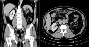 Masa renal con reforzamiento a 87UH en fase nefrográfica en paciente monorreno. Posee un puntaje de 7 por R.E.N.A.L. (R=2; E=1; N=1, L=3), clasificándose como masa de complejidad moderada. Se realizó nefrectomía parcial por laparoscopia.