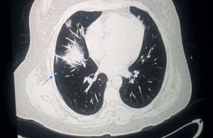 Metástasis pulmonar en lóbulo inferior derecho (flecha).