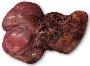 Pieza quirúrgica donde se observa el componente mixto.