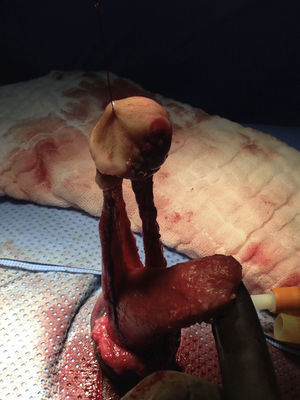 Desmontaje finalizado; nótese separación anatómica completa del glande, complejo neurovascular y uretra de los cuerpos cavernosos.