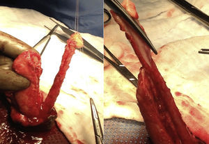 Espatulación ventral de uretra distal para creación de neoglande.