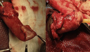 a) Eversión de mucosa uretral sobre cuerpos cavernosos. b) reconstrucción circunferencial para dar la apariencia de un neoglande.