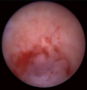 Aspecto endoscópico de tumor urotelial inferior a lito en unión ureteropiélica.