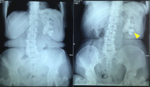 Radiografía simple de abdomen de pie y decúbito con evidencia de lito coraliforme izquierdo.