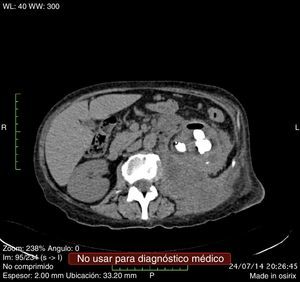Tomografía computarizada, corte axial.