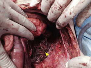Afección de tejidos retroperitoneales, fístula en músculo psoas.