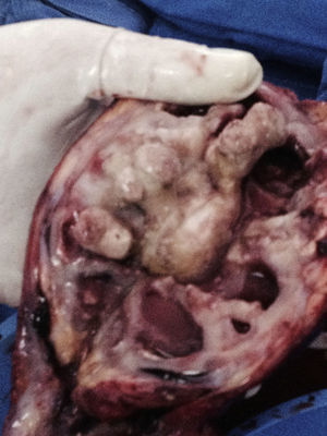 Unidad renal Izquierda con lito coraliforme en su interior.