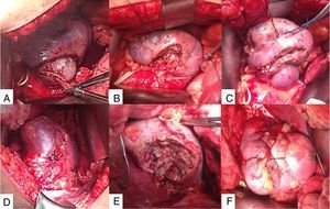 Nefrectomía parcial bilateral simultánea. A, B y C. Resección de tumoración renal izquierda. D, E y F. Resección de tumoración renal derecha. En ambos procedimientos se pinzó hilio renal con torniquete de Rummel.
