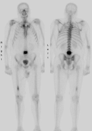Gammagrafía ósea 99mTc-HDP de cuerpo completo con irregular distribución del radiofármaco a nivel de raquis con foco de captación de acusada intensidad a nivel de L4/L5 así como aumento de reacción osteogénica en tercio distal de fémur derecho.