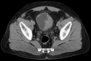 TAC de abdomen contrastada donde se aprecia infiltración tumoral en vejiga.