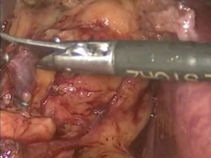 Clipaje metálico de vena suprarrenal y sección con tijera laparoscópica.
