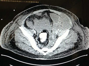 Corte axial a nivel de pelvis, mostrando la colección e infiltrado de lado izquierdo.