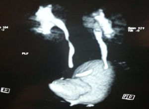 Uro-TAC: se aprecia divertículo paraureteral derecho y reflujo vesicoureteral GII.