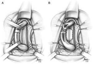 Anastomosis e injerto. En la figura A se identifica la zona estrecha (delineada) y se reseca. Se prolonga la incisión posterior para preparar el injerto. En la figura B, se coloca el injerto y se realiza la anastomosis.