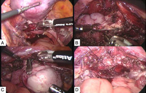 Histerectomía laparoscópica transperitoneal.