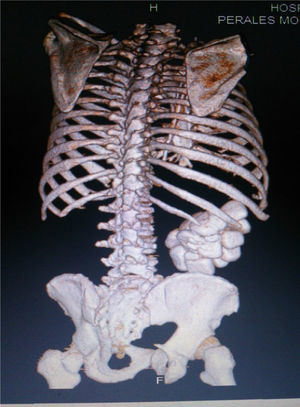 TAC simple de abdomen: reconstrucción vista posterior.