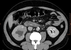 TAC abdómino-pélvica donde se aprecia ectasia renal secundaria a lesión ocupante de espacio al nivel de la pelvis renal.