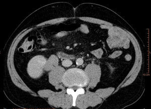 TAC abdómino-pélvica, continuación de la anterior, donde se aprecia que la lesión ocupante de espacio se extiende al uréter proximal derecho.