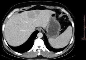 TAC abdómino-pélvico donde se aprecian 2 LOES hepáticas.