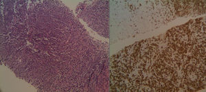 Biopsia de cilindro de lesión en la pelvis renal en la que se aprecia extenso infiltrado linfocitario, que se marca con CD20.