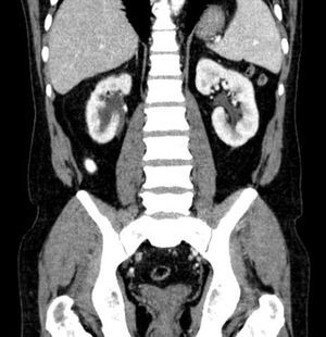 Reconstrucción de imagen de TAC abdominal tras finalizar el tratamiento.