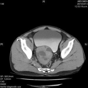 Imagen tomográfica donde se puede apreciar gran tumoración en topografía de vesícula seminal derecha, que involucra a la glándula prostática.