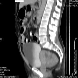 Imagen tomográfica en corte sagital izquierdo. Confirmando la lesión tumoral en zona prostática.