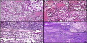 A: carcinoma renal de células claras; se observan células neoplásicas con abundante citoplasma claro y núcleos pleomórficos con nucléolo prominente que alternan con una fina trama vascular. B: carcinoma renal de células claras con áreas rabdoides; las células presentan acentuado pleomorfismo y citoplasma abundante eosinófilo de características rabdoides. C: invasión a páncreas por el componente rabdoide. D: ganglio linfático con reacción granulomatosa crónica y células gigantes tipo Langhans.