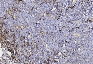 Inmunomarcación con actina de músculo liso que muestra expresión en células de componente estromal.