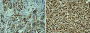 Inmunohistoquímica. A) Melan A positividad en citoplasma de células neoplásicas (400×). B) S-100 positivo intenso en citoplasma de células neoplásicas (400×).