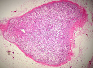 Microfotografía de nódulo de tejido suprarrenal rodeado por tejido graso (lipoma de cordón espermático).
