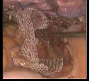 Fijación de malla a la vagina y promontorio sacro.