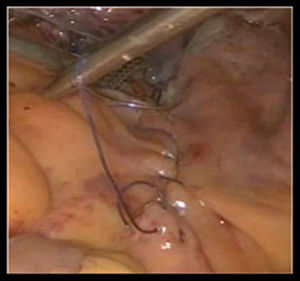 Cierre del peritoneo parietal posterior sobre la malla.