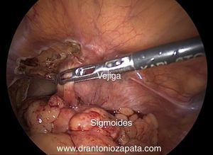 Liberación de vejiga y separación de sigmoides.