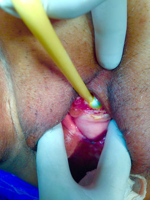 Aspecto de la uretra con prolapso de mucosa uretral y visualización del globo de la sonda.