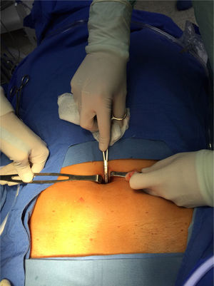 Se observa incisión por debajo de la cicatriz umbilical y disección cuidando no abrir peritoneo.